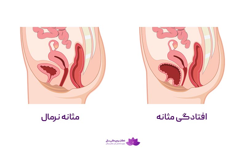 افتادگی مثانه چیست؟ تصویر مثانه نرمال و سیستوسل در زنان