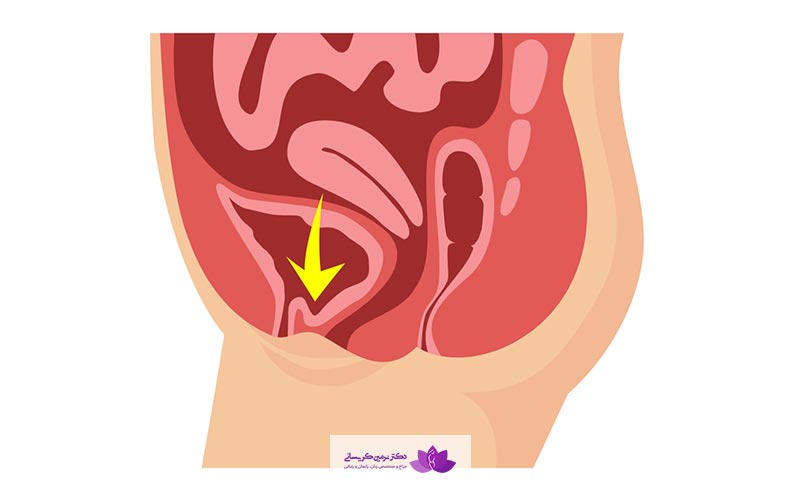 افتادگی رحم و یا مثانه در زنان چیست