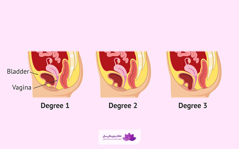 انواع افتادگی رحم (بیرون زدگی رحم یا پرولاپس رحم - سیستوسل)