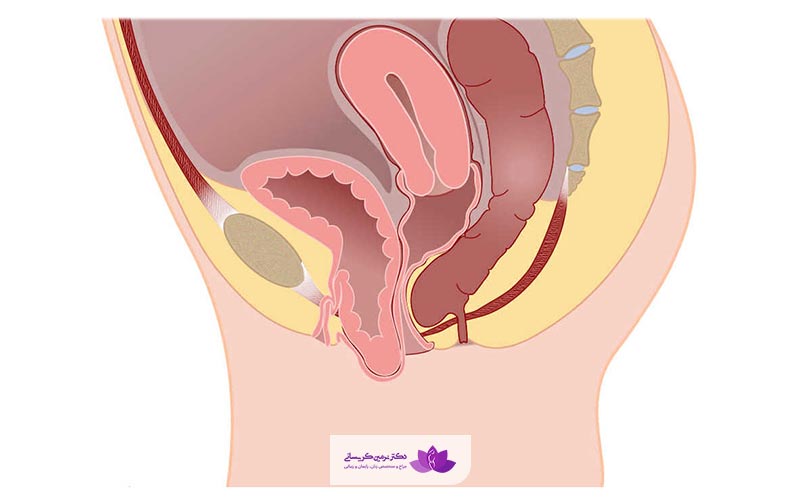علائم افتادگی رحم دختران و زنان