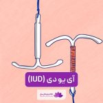 آی یو دی IUD چیست و چطور از بارداری جلوگیری میکند