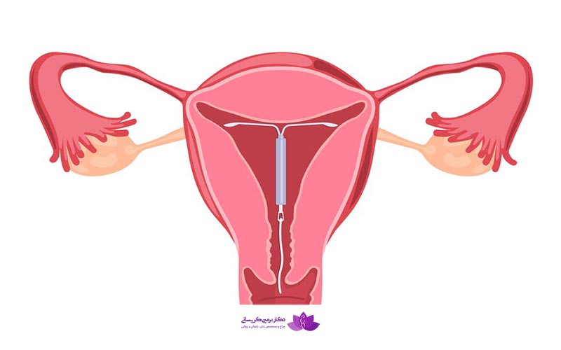 برای جلوگیری از بارداری آی یو دی بهتر است یا قرص ضدبارداری و اورژانسی؟