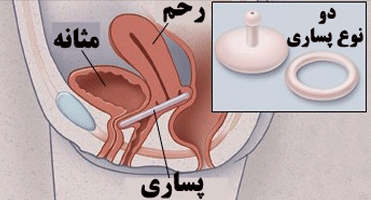 استفاده از پساری برای افتادگی مثانه