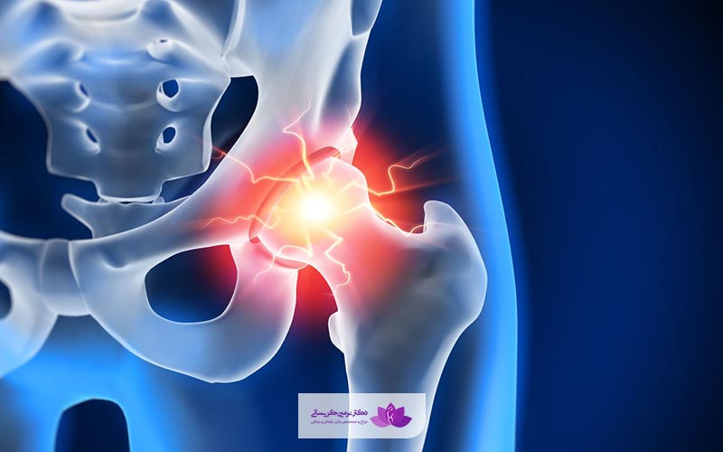 یکی دیگر از دلایل درد لگنی دختران آندومتریوز است