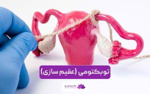 توبکتومی چیست و چگونه انجام می شود؟ نحوه عقیم سازی و بستن لوله رحمی در زنان