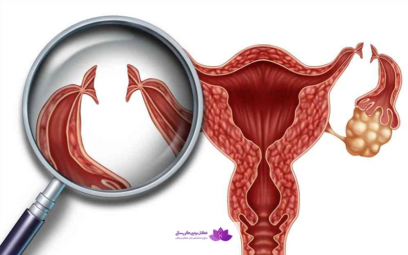 توبکتومی چیست و نحوه انجام بستن لوله رحمی چگونه است