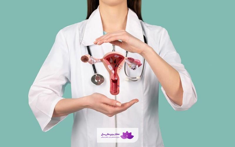 درمان کیست تنبلی تخمدان