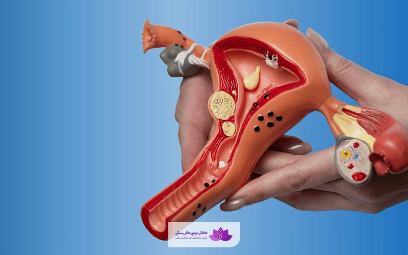 علائم و علل افتادگی رحم و مثانه در زنان